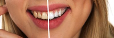 Home Remedies to Remove Stains From Dentures - image