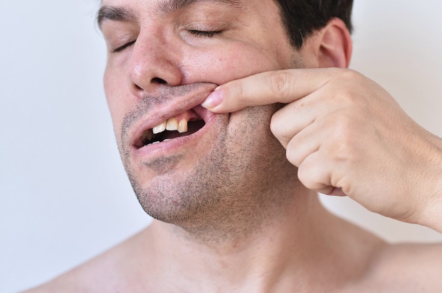 Fractured or Broken Teeth